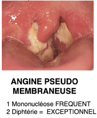 Angine pseudo membraneuse