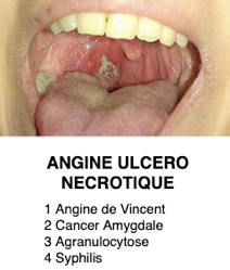 Angine ulcéro-nécrotique