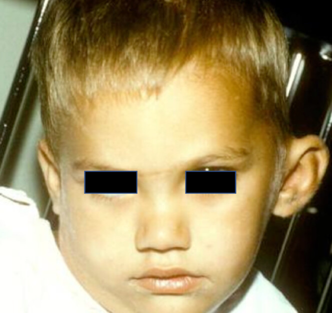 Enfant présentant une mastoïdite gauche
