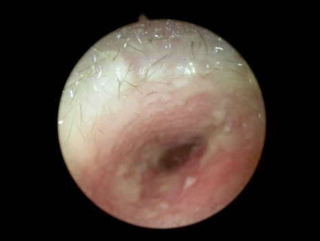 Site externe : Conduit auditif externe fermé par l’inflammation cutanée, dans une otite externe on ne voit jamais le tympan