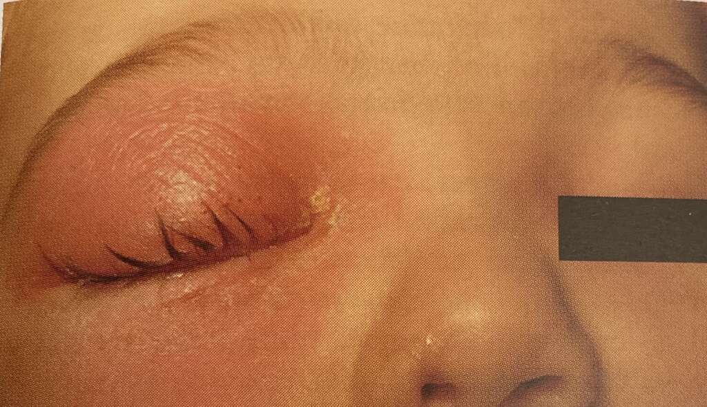 Œdème palpébral lors d'une ethmoïdite droite de l'enfant