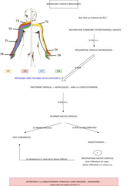 Conduite à tenir en cas de névralgie cervico-bracchiale