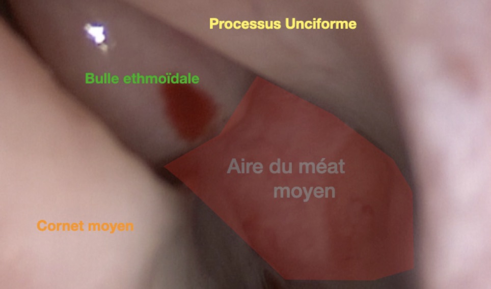 Complexe ostio-méatal gauche en vue endoscopique