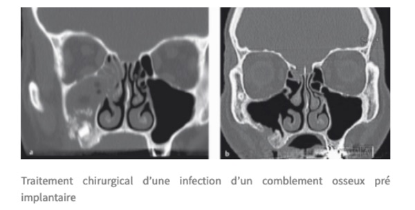 Pansinusite antérieure
