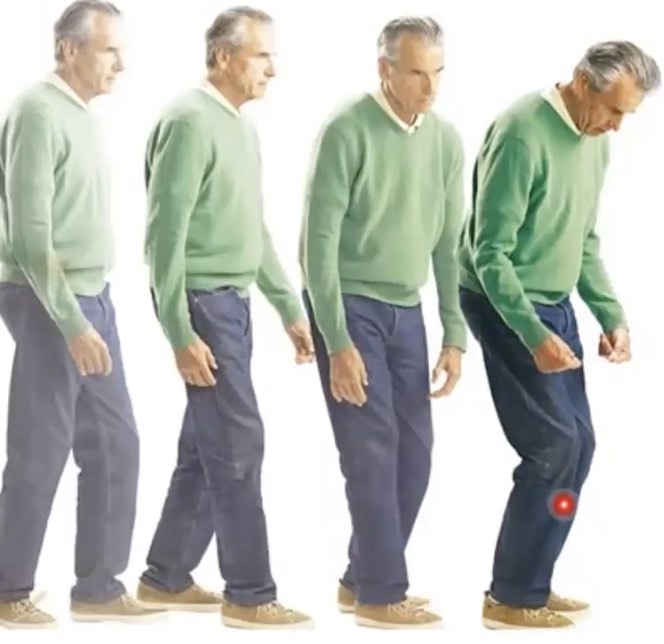 évolution naturelle de la posture dans la maladie de Parkinson
