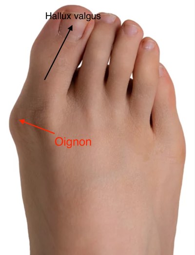 Hallux Valgus