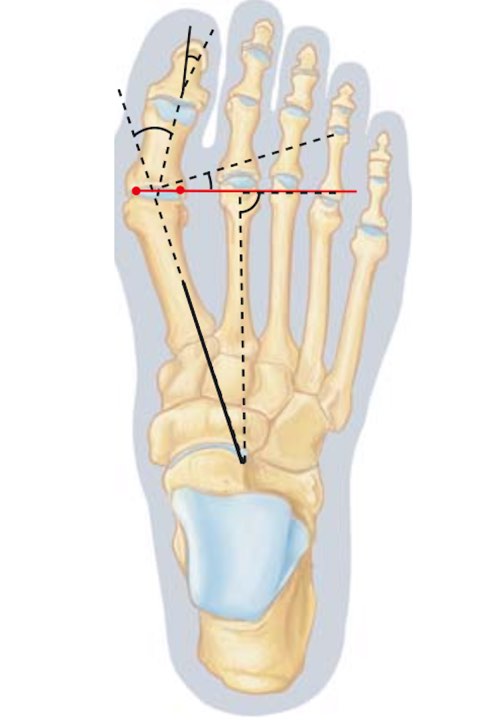 Hallux Valgus
