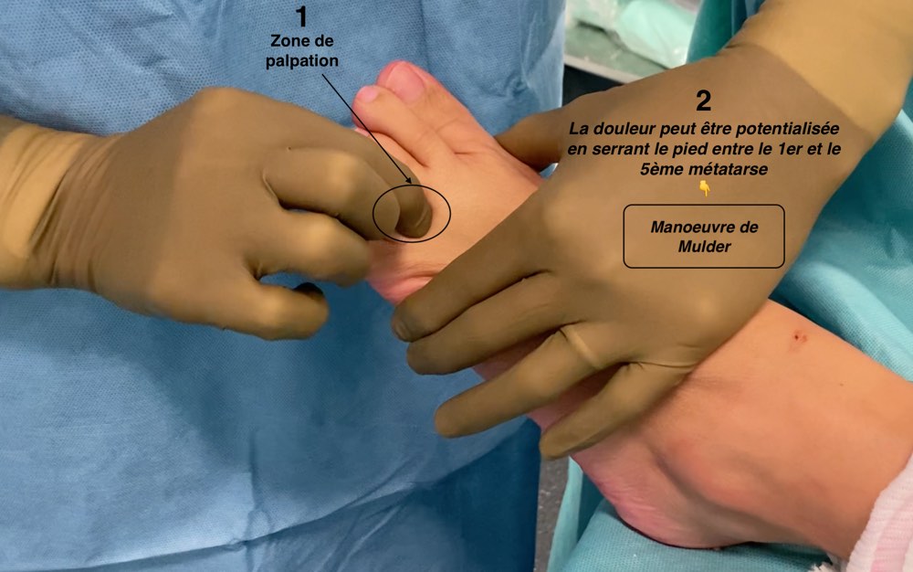 Anatomie de surface d’un névrome 