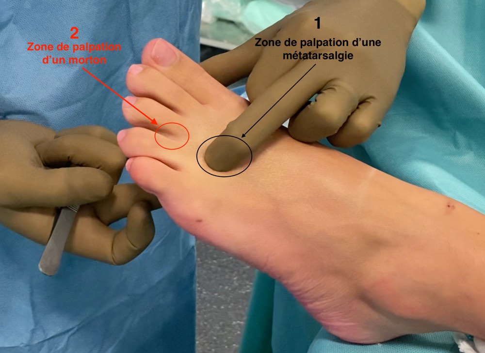 Différence Morton et Métatarsalgie 