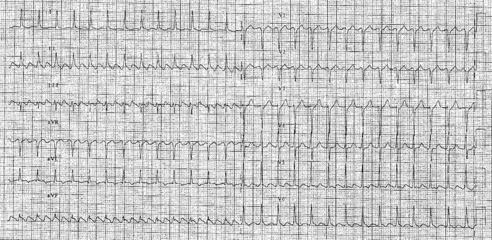 Flutter 2/1 => 2 F pour un QRS