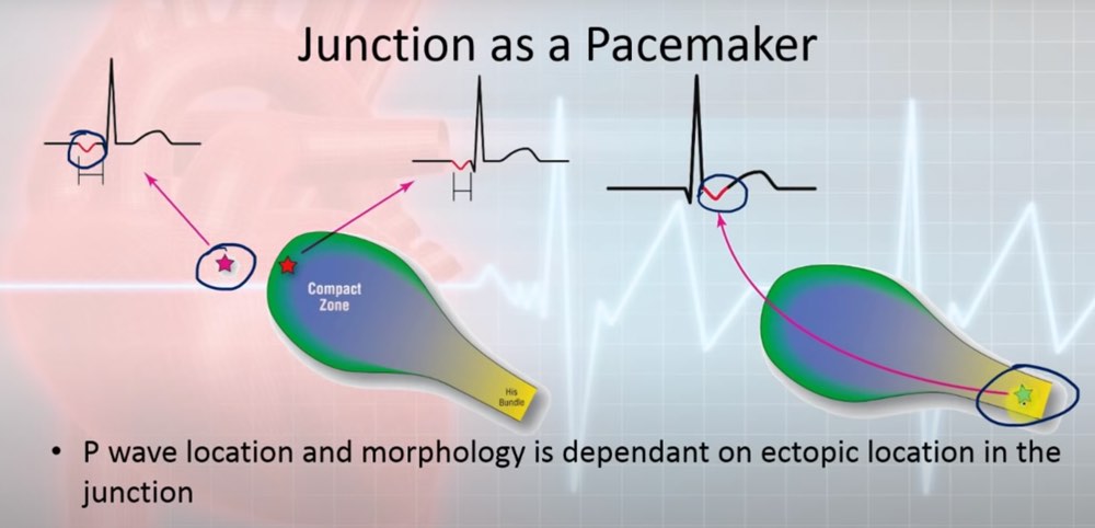 Distance entre P et le QRS selon la localisation du point de départ du cycle cardiaque dans le zone de jonction du NAV