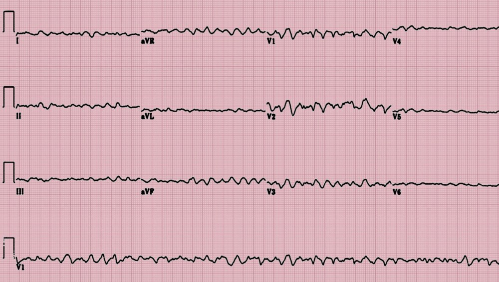 Fibrillation ventriculaire