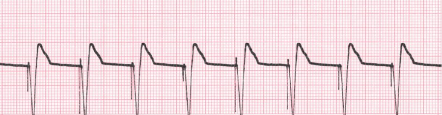 Spikes suivis de QRS = PM ventriculairel