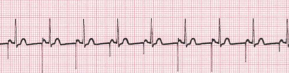 Spikes suivis d’onde P = PM atrial