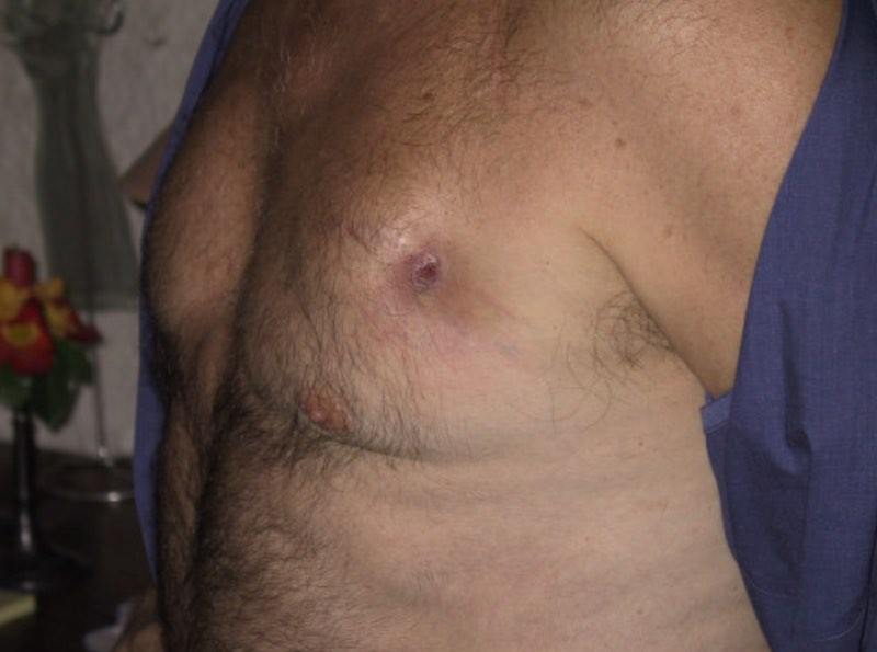 Souffrance cutanée => cs cardiologique pour avis