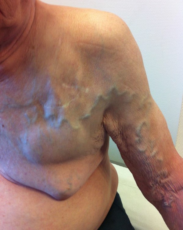 Réseau veineux superficiel trop visible car thrombosé
