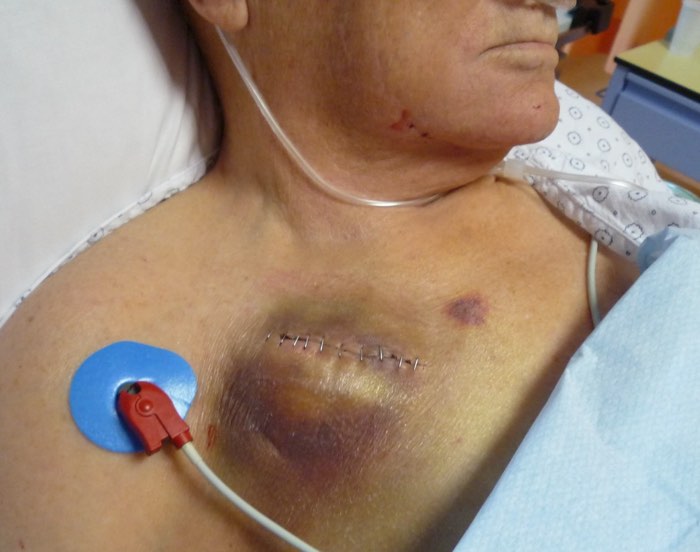 Hématome post op indiquant une cs cardio 