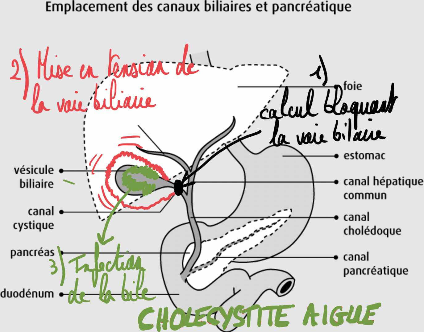 Dessin schématique de la cholécystite aiguë
