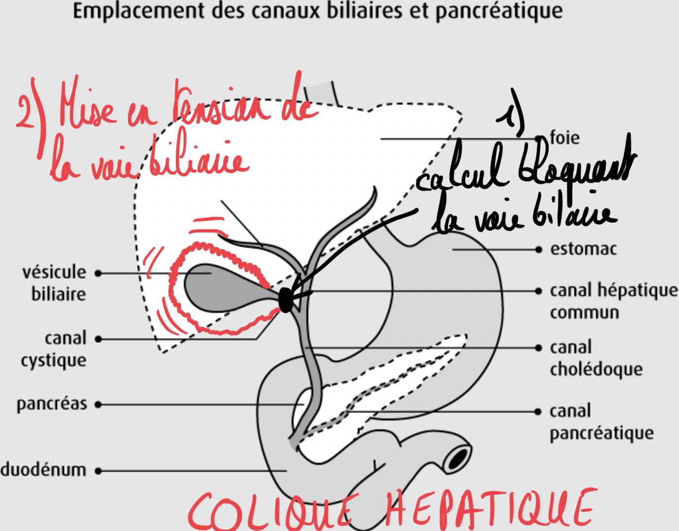 Dessin colique hépatique 