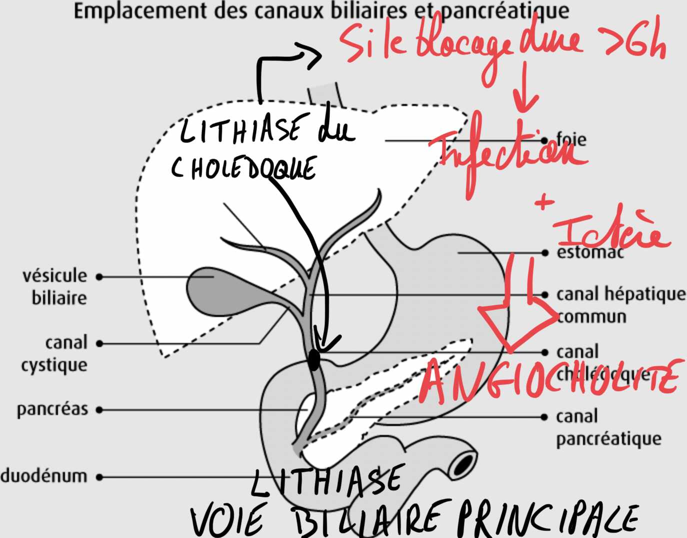Dessin angiocholite