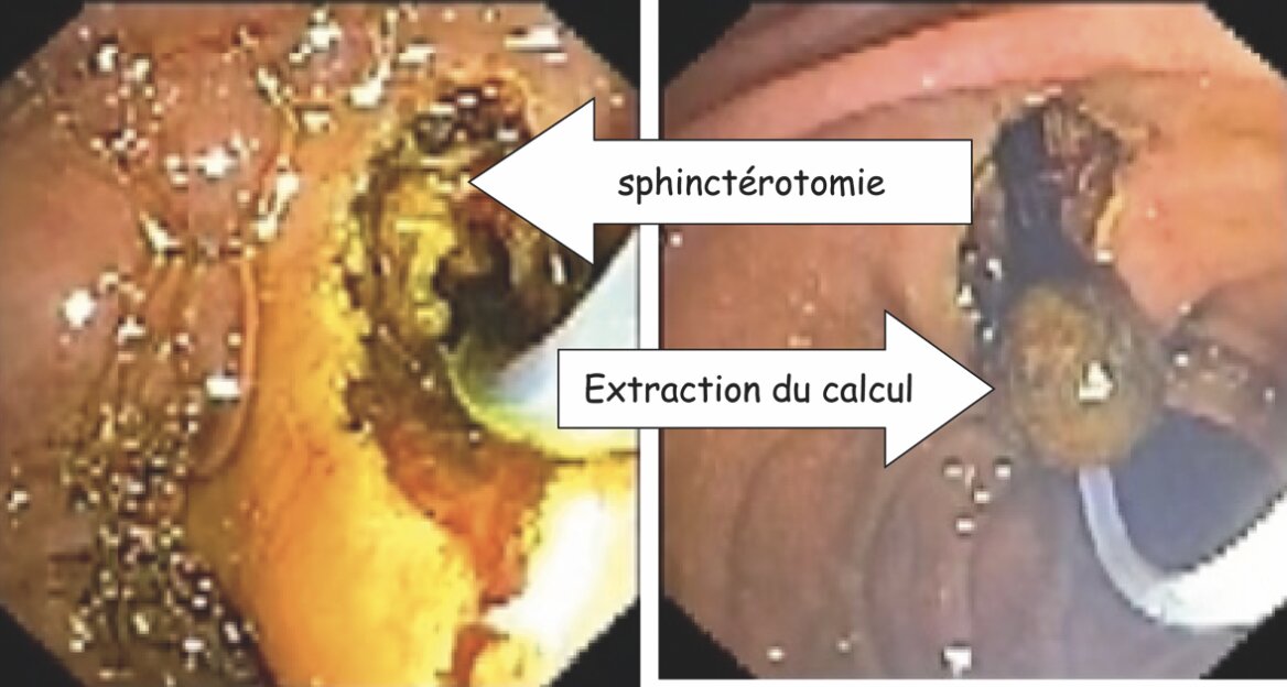 Sphincterotomie-Extraction du calcul