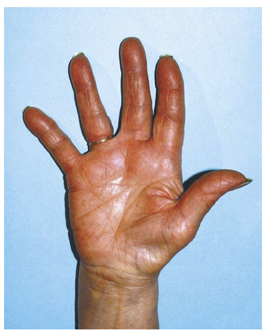 Amyotrophie de l'éminence thénarienne 