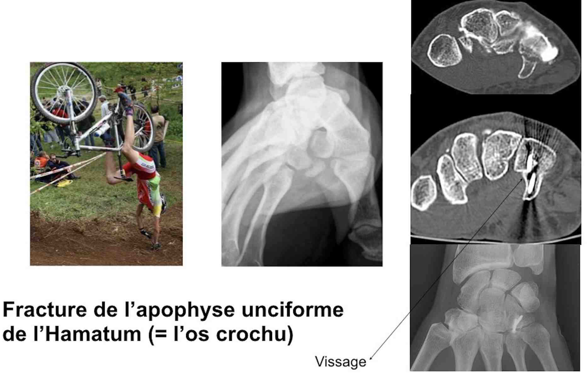 Fracture hamatum vélo 