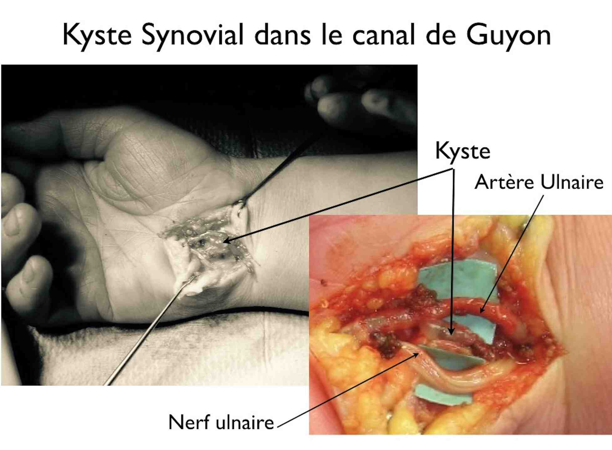 Kyste synovial 