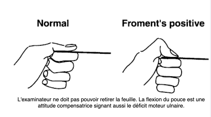Signe de Froment