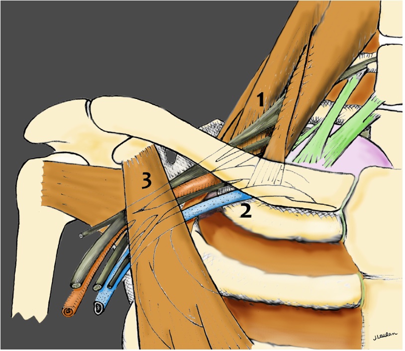 Sites de compression du syndrome du défilé cervico thoracique 