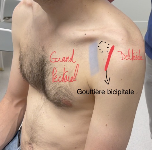 Gouttiere-bicipitale-epaule-dpc-odpc-andpc-mg