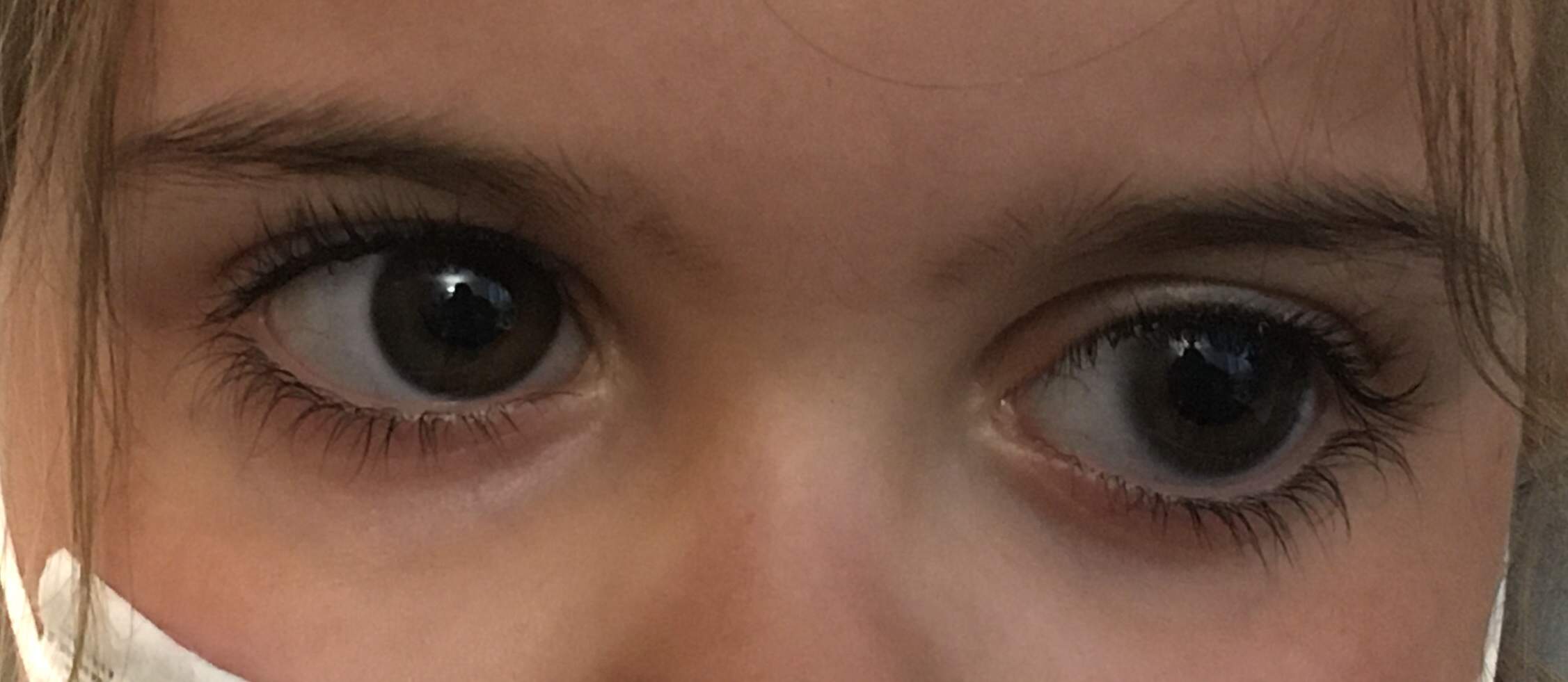 Glaucome-congenital-buphtalmie
