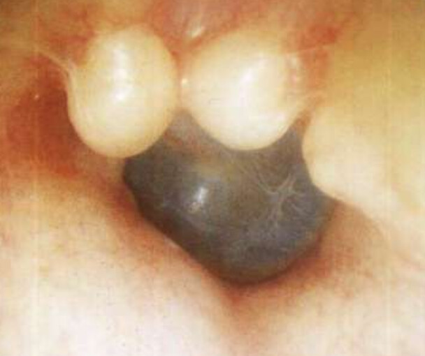 osteome-exostose-conduit-dpc-medecine-generale-otoscopie