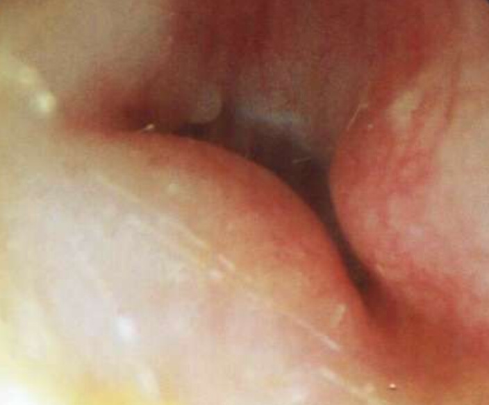 osteome-exostose-tympan-oreille-dpc-medecine-generale