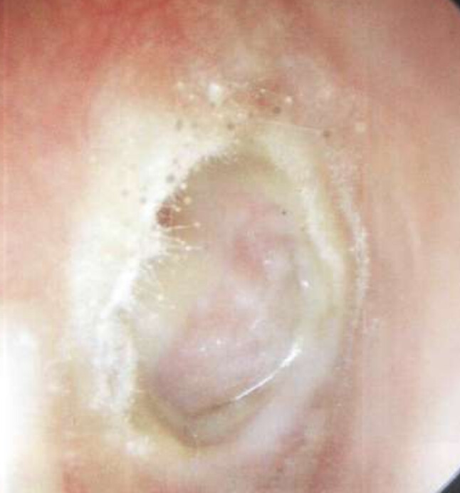 otomycose-otite-externe-dpc-medecine-generale