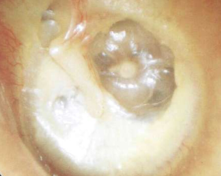 poche-retraction-tympan-otoscopie