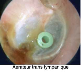 aerateur-trans-tympanique-otite-sereuse