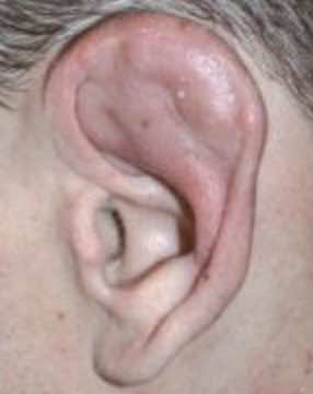 hematome-oreille-othematome-dpc-medecine-generale