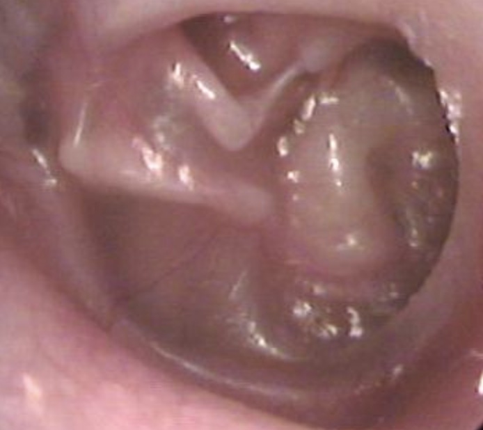Otite-atelectasique-tympan-dpc-medecine-generale
