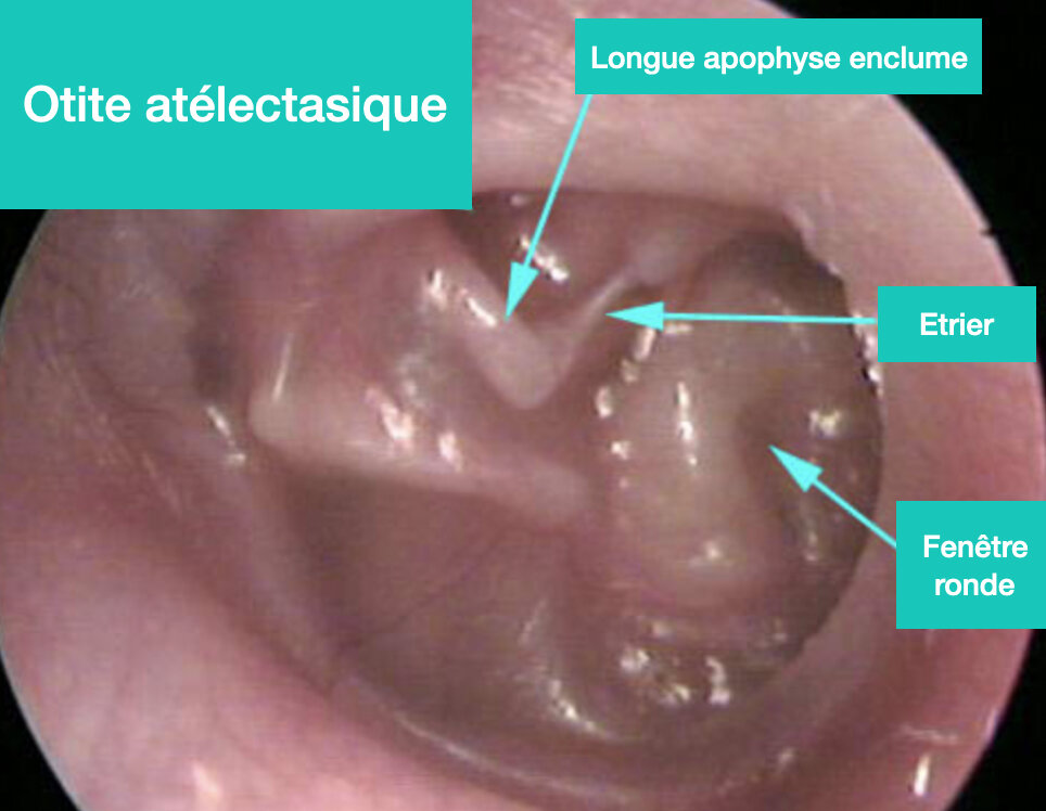 Otite-atelectasique-tympan-otoscopie