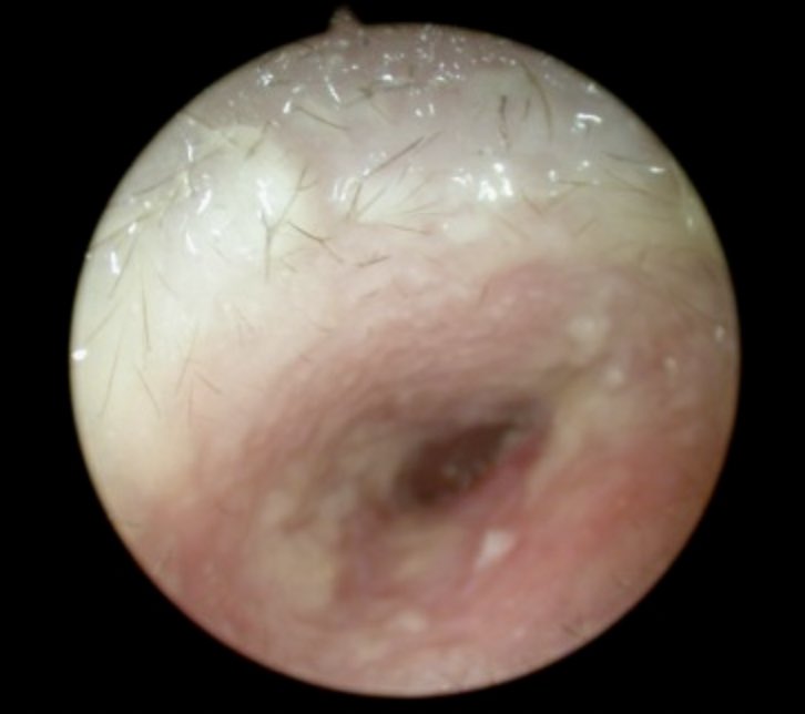 otite-externe