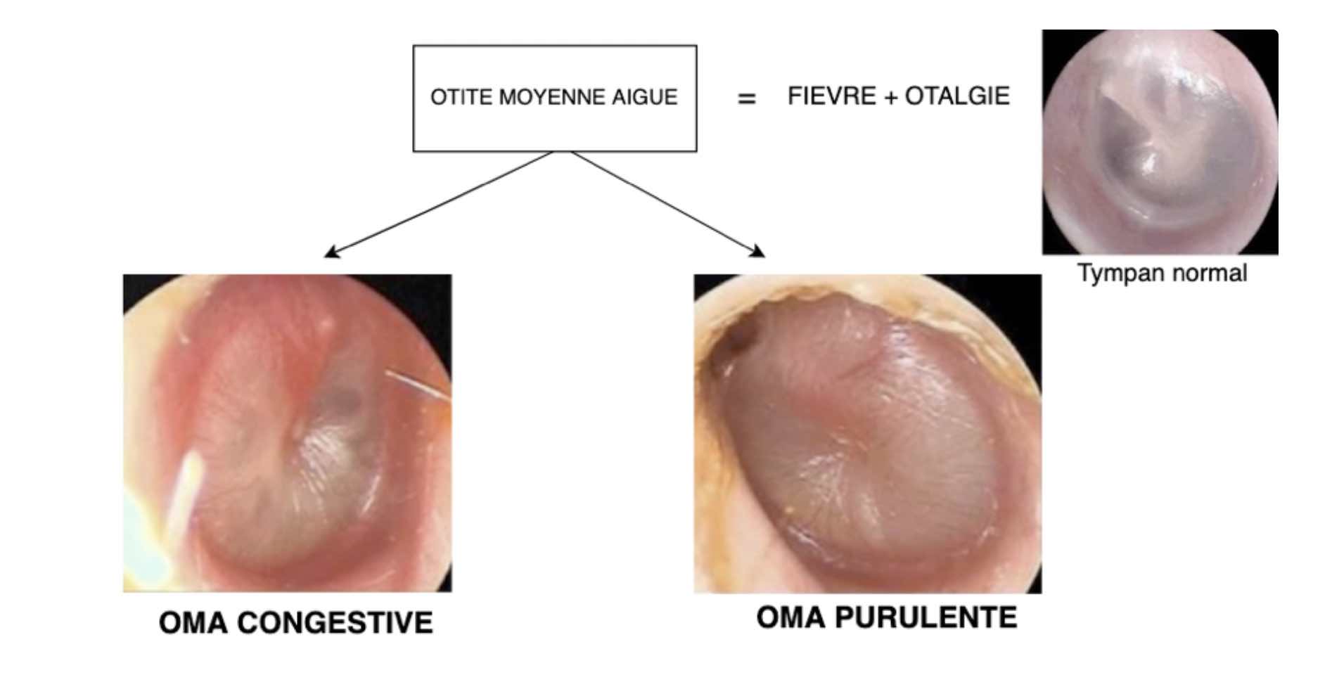 otite-congestive-otite-collectee