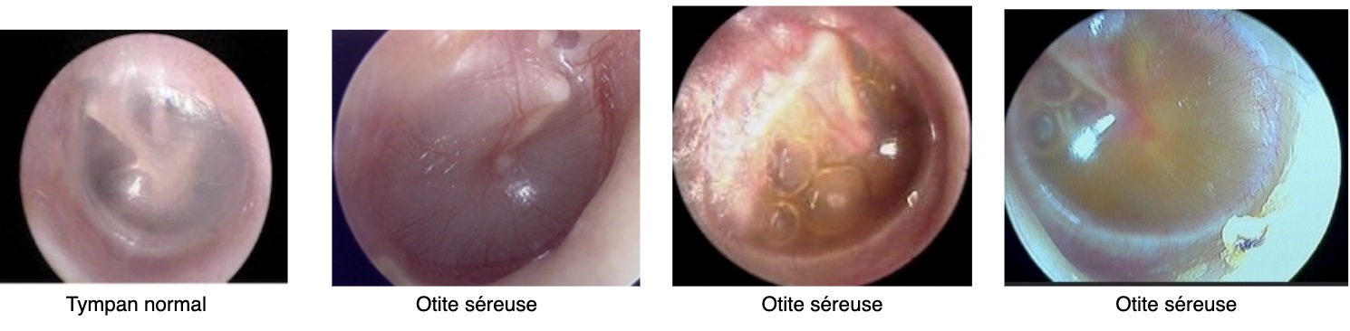Otite séreuse otite séromuqueuse otite muqueuse 