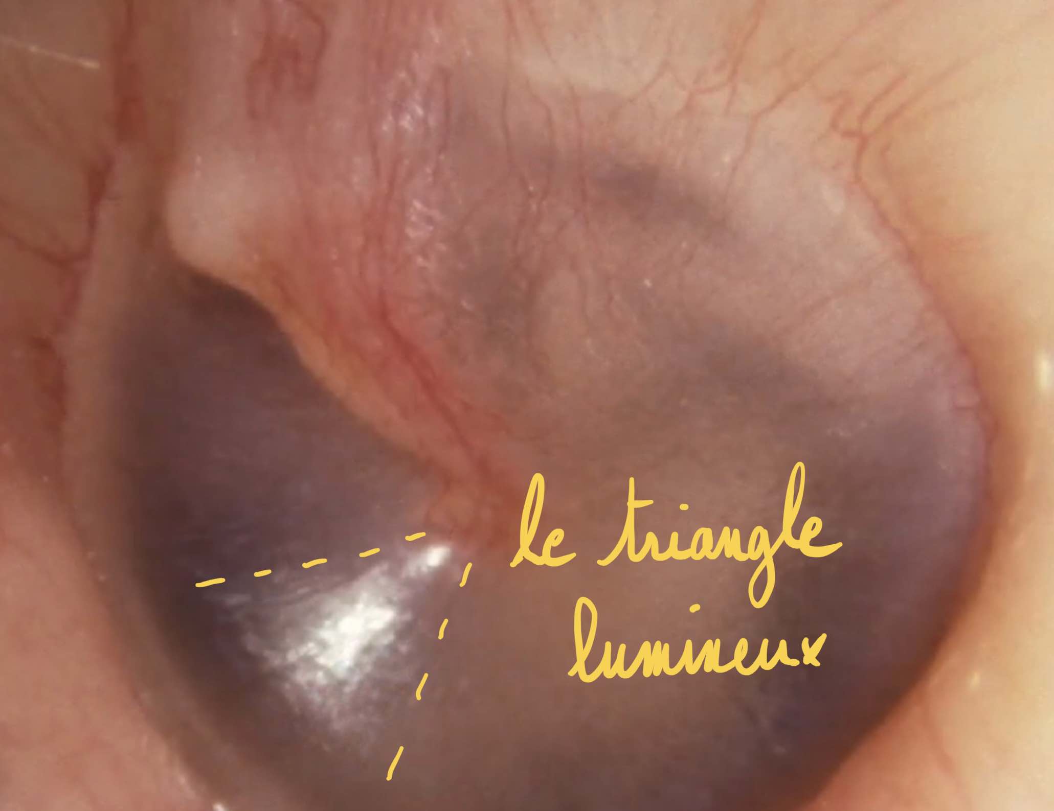 Otoscopie-tympan-normal-triangle-lumineux
