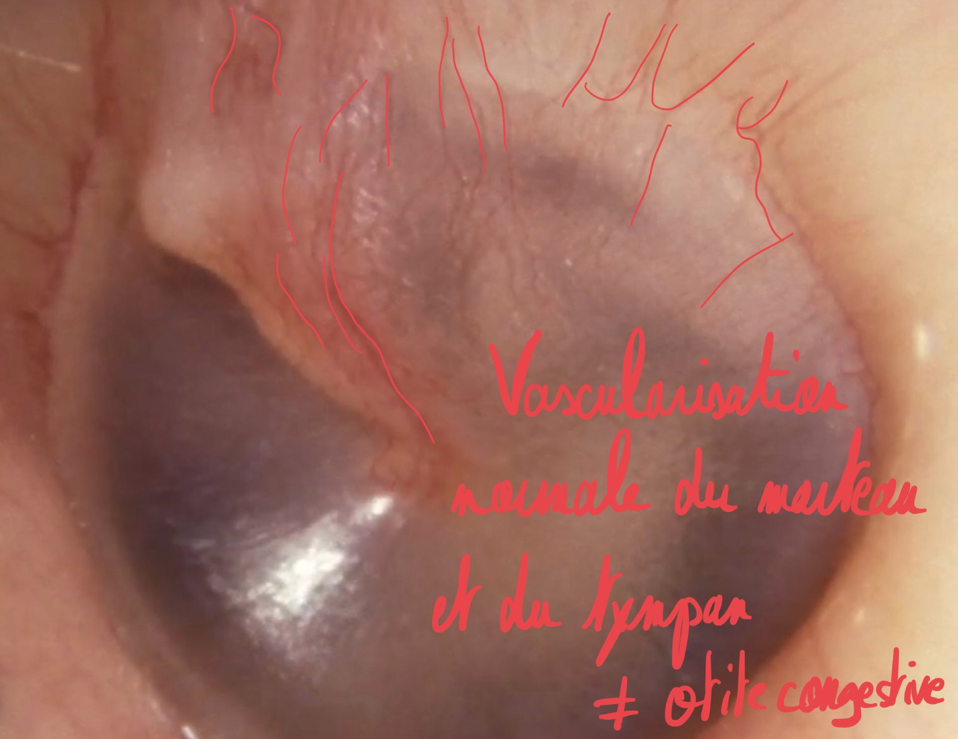 Otoscopie-tympan-normal-vascularisation