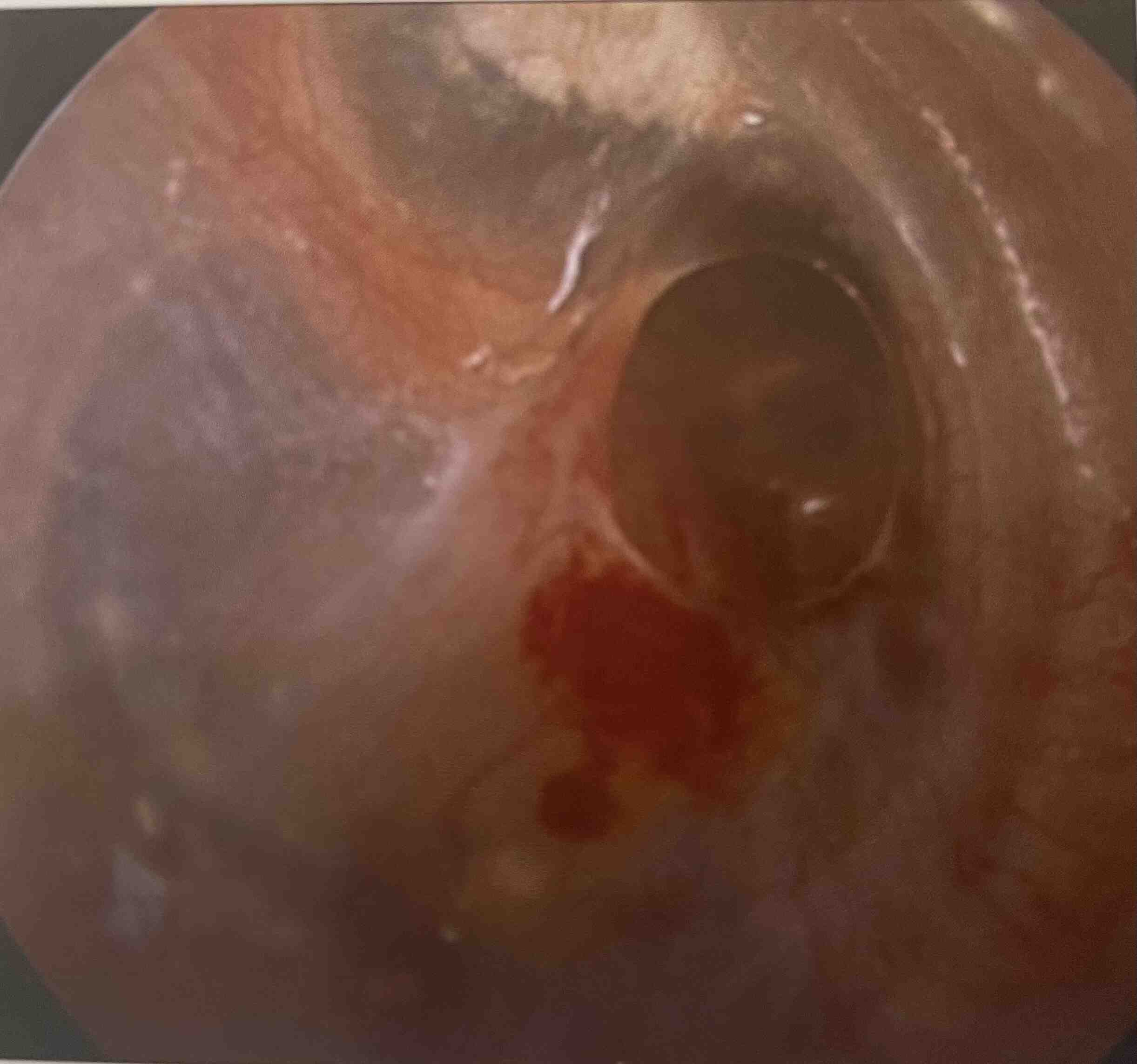 perforation-tympan-otosccopie