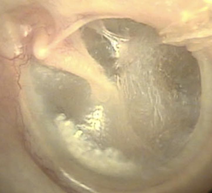 tympanosclerose-tympan-otoscopie-otite-dpc-medecine-generale