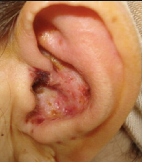 zona-oreille-pavillon-dpc-medecine-generale