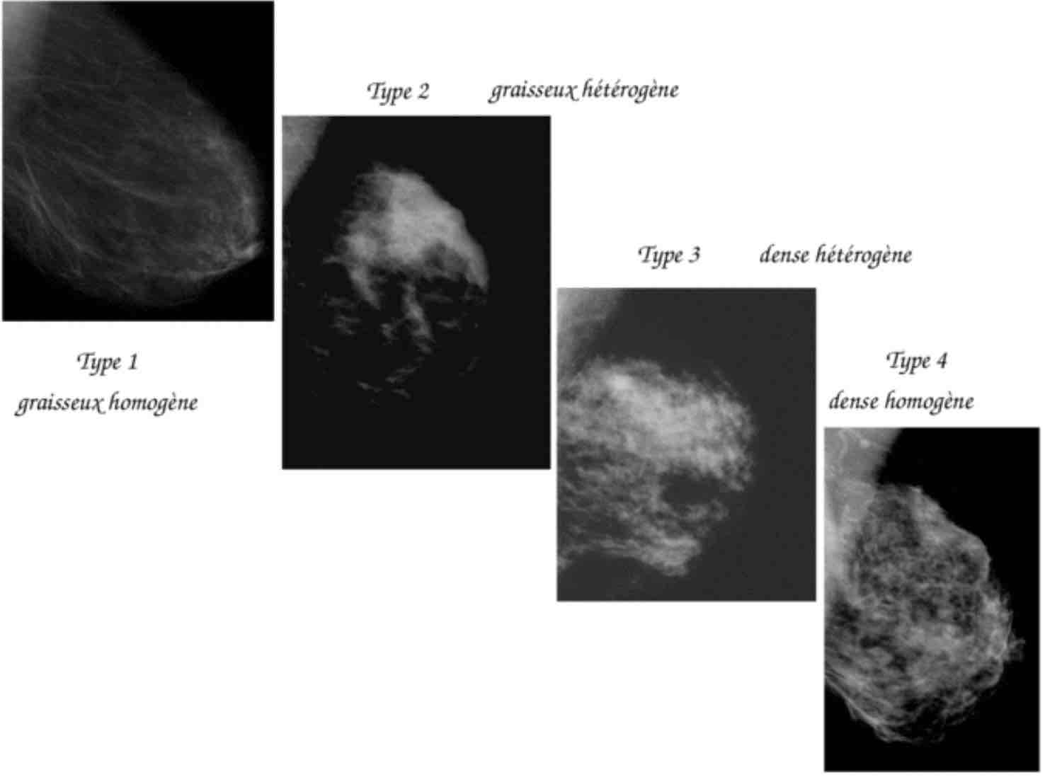birads-sein-mammographie-cancer-femme