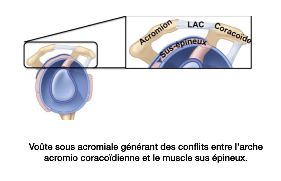 conflit-sous-acromial-epaule-medecine-generale